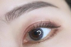 嘉兴双眼皮修复术后恢复